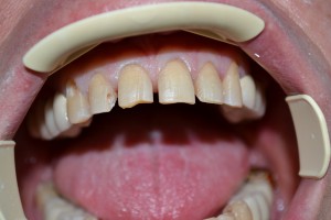3. Препаровка под Компониры (все зубы оставлены живыми.)