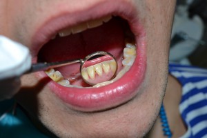 Снятие зубных отложений в Сумах. Снять камни