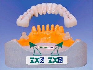 Zubnoe-protezirovanie-na-steklyannyih-oporah-v-g.-Sumyi-300x227