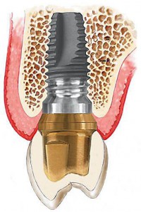 Ускладнення імплантації зубів