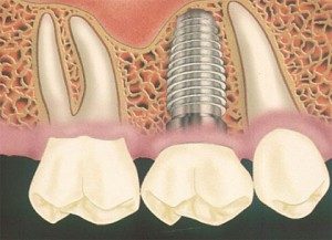 имплантация зубов Сумы