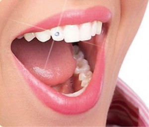 Інкрустація зубів