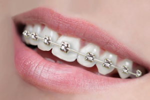 Titanium braces