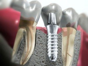 zubnoy-implantat-sumyi-300x225