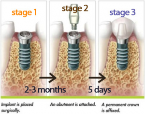 Stages of teeth implantation
