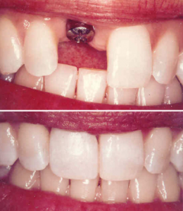 Single tooth implantation