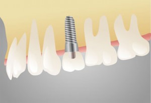 Різноманіття зубних імплантів