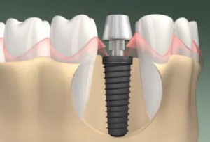 Сучасні методи імплантації зубів