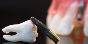 Що собою являє зубний імплантат