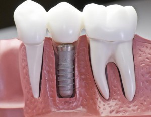имплантация-зубов