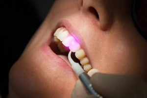Лазер в стоматологии