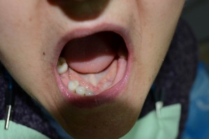 Частичная потеря зубов на нижней челюсти