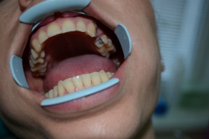 В 25 зубе глубокая кариозная полость