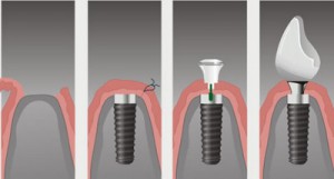 etapi-implantacii-zubov-1