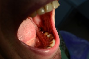 Имплантированы боковые 6 и 7 зубы