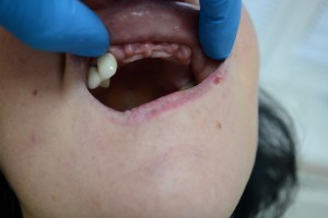 Вид верхней челюсти до протезирования
