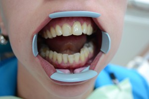 До реставрации зуба материалом Мегафил (Германия)