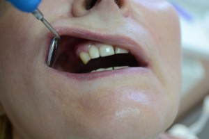 До протезирования. У пациента двухсторонние концевые дефекты зубов