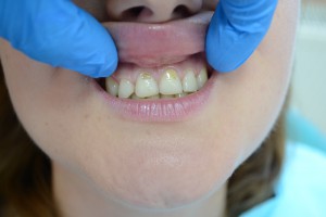 До реставрации зубов материалом Gradia GC