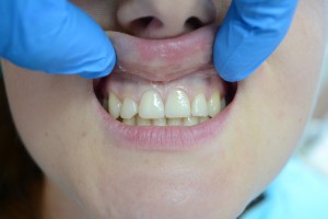 Передние 21 и 11 зубы отреставрированы фотополимером Gradia GC