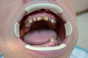 Обточенные зубы