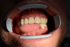 До протезирования зубов