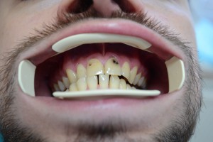 Кариозные поражения передних зубов
