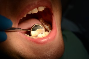 После проведения профессиональной чистки зубов