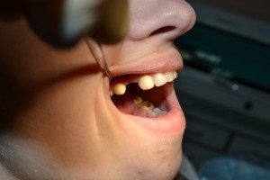 До протезирования зубов