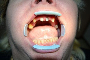 До протезирования зубов металлокерамикой