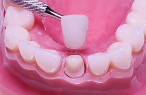 Фарфоровые зубы