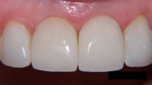 Металлокерамика на передние зубы