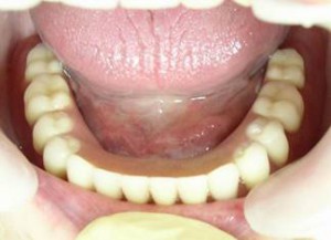 Протезирование нижних зубов