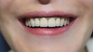 Установка металлокерамики на передние зубы