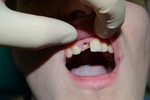 Ситуация до протезирования зуба