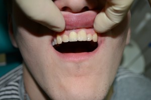После протезирования зуба