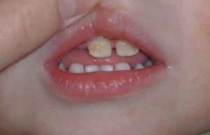 Фторирование молочных зубов