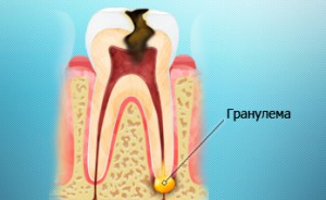 Гранулема зуба