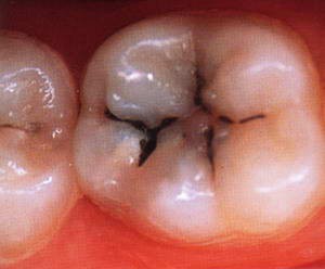 Кариес зубов. Причины заболевания