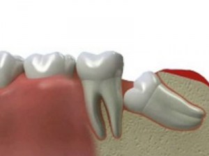Симптомы ретенции зуба