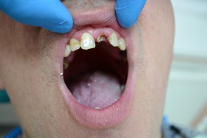 Разломавшийся зуб, что делать?
