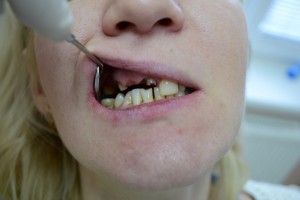 Зубные дефекты