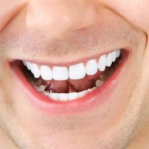 Отбеливание зубов по системе ZOOM