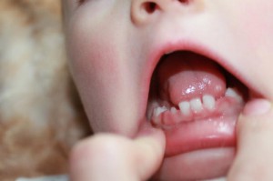 глазные зубы ребенок