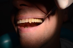 После протезирования зубов