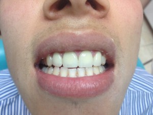После протезирования зубов