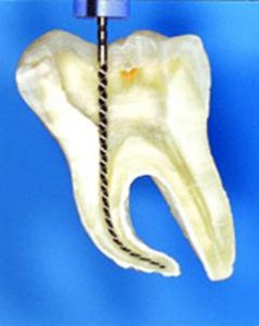 Лечение каналов зуба в Сумах
