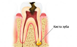Лечение кисты зуба в Сумах
