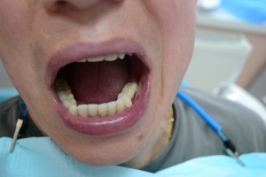 Импланты во рту с коронками