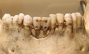 Зубные протезы были известны более 4000 лет назад